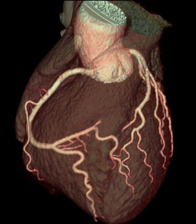 Reconstrucción en 3D de las arterias coronarias