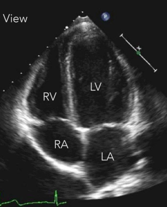 Ecocardiograma: vista de las cuatro cámaras del corazón