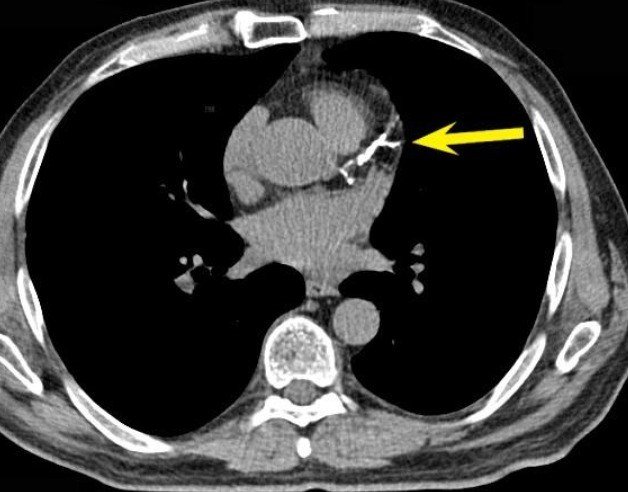 Tomografía que muestra calcio en una arteria coronaria